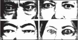 У хворих на тиреотоксикоз спостерігаються й інші очні симптоми: 1. Елінека - пігментація повік. 2. Меліхова - гнівний погляд. 3. Штельвага -широка очна щілина, рідке кліпання. 4. Грефе - відставання верхньої повіки при русі ока донизу. 5. Мебіуса - порушення конвергенції очей (відхилення очного яблука назовні при фіксації зору зблизька). 6. Дальрімпля - різні очні щілини. 7. Кохера - нездатність зажмурити очі.