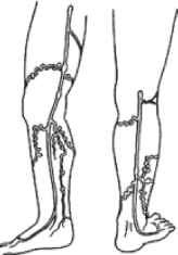 Мал. 14.1. Розподіл варикозних вен у нижній кінцівці: а - система великої підшкірної вени; б - система малої підшкірної вени.