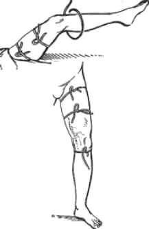 2. Гаккенбруха (симптом "кашльового поштовху"). До місця впадання великої підшкірної вени в стегнову прикладають руку і пропонують хворому покашляти. При недостатності клапана в ділянці впадання вени відчувається поштовх.