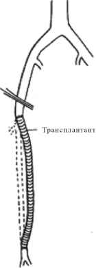 При облітерації артерії в стегново-підколінному сегменті проводять стегново-підколінне (мал. 15.5) або стегново-тибіальне шунтування сегментом великої підшкірної вени. Перевагу віддають автовені, оскільки синтетичні протези тромбуються вже в найближчий час після операції.