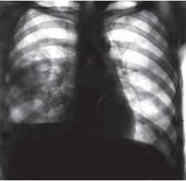 Хронічний абсцес легень виникає у 12-15 % випадків при існуванні легеневого нагноєння понад 6-8 тижнів, клінічно характеризується циклічним перебігом. У стадії ремісії хворі скаржаться на помірну задишку, кашель з виділенням слизистого або слизисто-гнійного харкотиння. При загостренні процесу з'являється кашель з великою кількістю (200-300 мл) гнійного харкотиння з неприємним запахом, посилюється біль у грудях, прогресує задишка, гектична температура з перепадами 1,5-2о. Запаморочення, зниження апетиту, загальна слабість збільшуються відповідно до наростання інтоксикації. Шкірні покриви бліді, спостерігається помірний акроціаноз, дихання прискорене до 2030 за хвилину. Нігтьові фаланги через 6-8 місяців захворювання набувають форми барабанних паличок, грудна клітка деформується, голосове тремтіння незначно послаблюється на боці ураження. Перкуторно - вкорочення перкуторного звуку в проекції патологічного процесу; аускультативно - велика кількість різнокаліберних вологих хрипів на фоні амфоричного дихання.