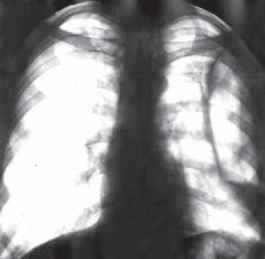 Решітчастою легенею називають процес після операції або пошкодження, коли до великого дефекту грудної клітки припаюється легенева тканина з численними дрібними бронхіальними норицями.