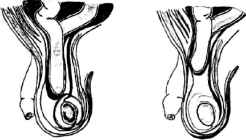 Косі пахвинні грижі виникають внаслідок випинання грижового мішка через внутрішнє пахвинне кільце, розміщене відповідно до зовнішньої пахвинної ямки. У цьому разі грижовий мішок повторює хід сім'яного канатика, розташовується всередині загальної піхвової оболонки, яка оточує з усіх сторін його елементи. Елементи канатика можуть займати різні місця відносно грижового мішка.