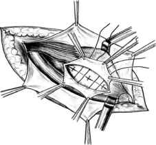 Мал. 2.10. Спосіб Кукуджанова (перший): 1 - шви на глибокий листок піхви прямого м'яза живота; 2 - шви на апоневроз прямого м'яза; 3 - шви на поперечну фасцію; 4 - шви на пахвинно-лобковий тяж; 6 -шви на внутрішній косий м'яз живота; 8 - шви на підсерозну оболонку.