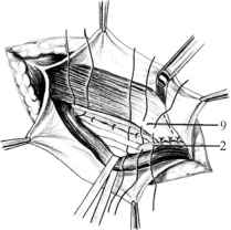  9 - шви на сухожилля внутрішнього косого і поперечного м' язів.