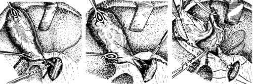 Вона полягає в тому, що спочатку в трикутнику Кало виділяють міхуро-ву протоку й артерію, роздільно їх пересікають між затискачами і перев'язують тонким капроном або шовком (мал. 14, а, б), а потім видаляють з ложа жовчний міхур, просуваючись від шийки до дна (мал. 14, в). За необхідності ревізувати гепатикохоледох куксу міхурової протоки тимчасово залишають під затискачем неперев'язаною.