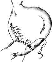 Мал. 6.4. Найбільш поширені операції на шлунку: а - стовбурова ваготомія з антрумектомією (Більрот-І); б - стовбурова ваготомія з антрумектомією (Більрот-ІІ); в - стовбурова ваготомія та пілоропластика; г - стовбурова ваготомія та гастроентероанастомоз.
